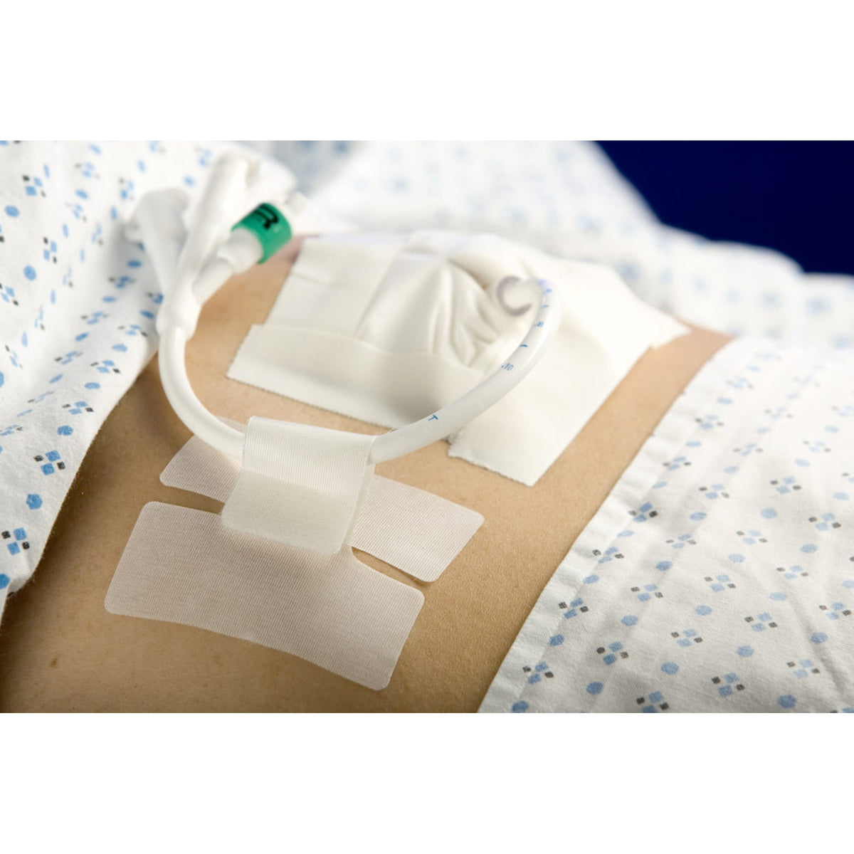 M.C. Johnson - Holder, Tube Cath-Secure™ Single Hook and Loop Tab, Hypoallergenic Tape, Butterfly Design [1/EA]